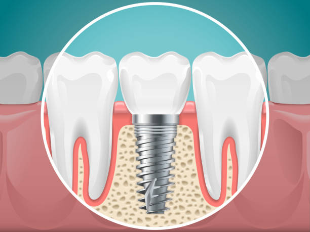 Everything You Should Know About Dental Implant Procedure In Singapore