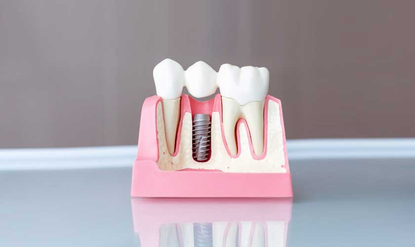 dental implant in Maple Ridge