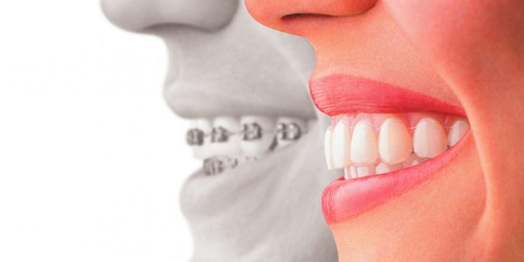 What Invisalign Can Do for You Whether You're A Teenager, Adult, Or A Senior