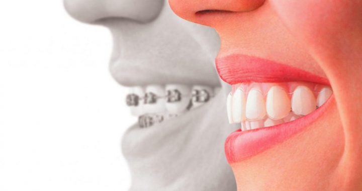 What Invisalign Can Do for You Whether You're A Teenager, Adult, Or A Senior