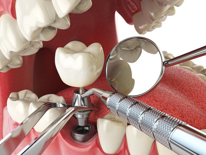 affordable dental implants in Richmond Hill