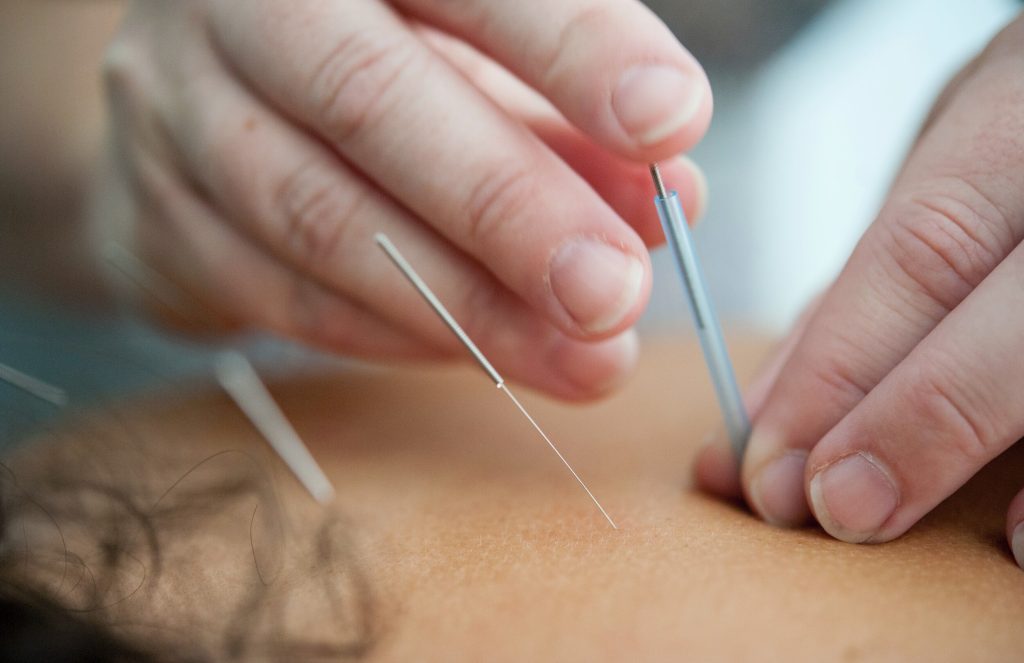 Medical Talks 101: Best-Selling Quality Acupuncture Needles