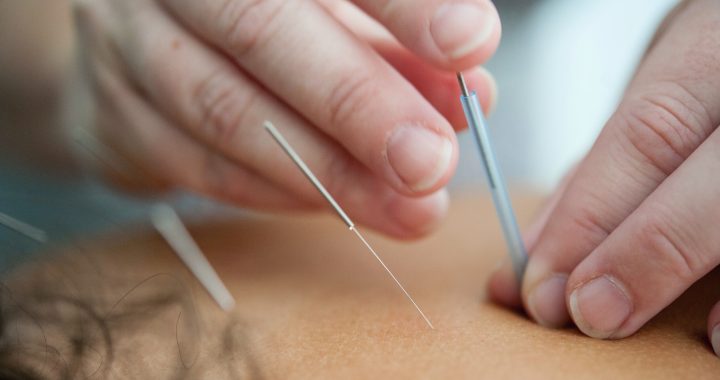 Medical Talks 101: Best-Selling Quality Acupuncture Needles