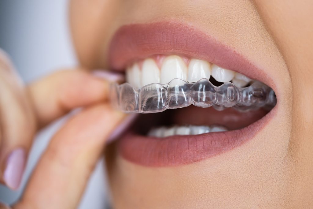 How Long Does It Take to Straighten Your Teeth with Aligners? Factors That Affect Treatment Time