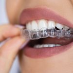 How Long Does It Take to Straighten Your Teeth with Aligners? Factors That Affect Treatment Time
