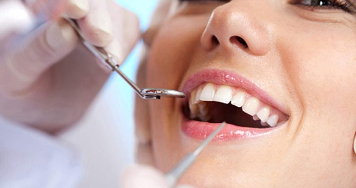A Full Guide for Installing Composite Dental Veneers
